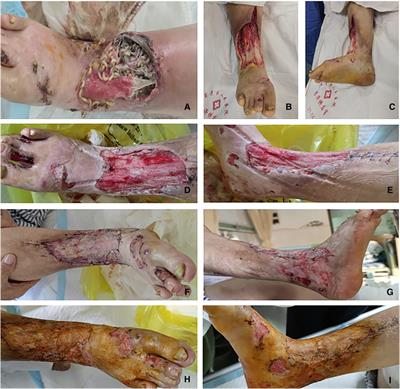 Atrophie blanche complicated with lower limb infection and maggot growth: A case report